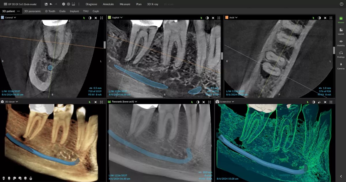 Root canals DTX STUDIO CLINIC