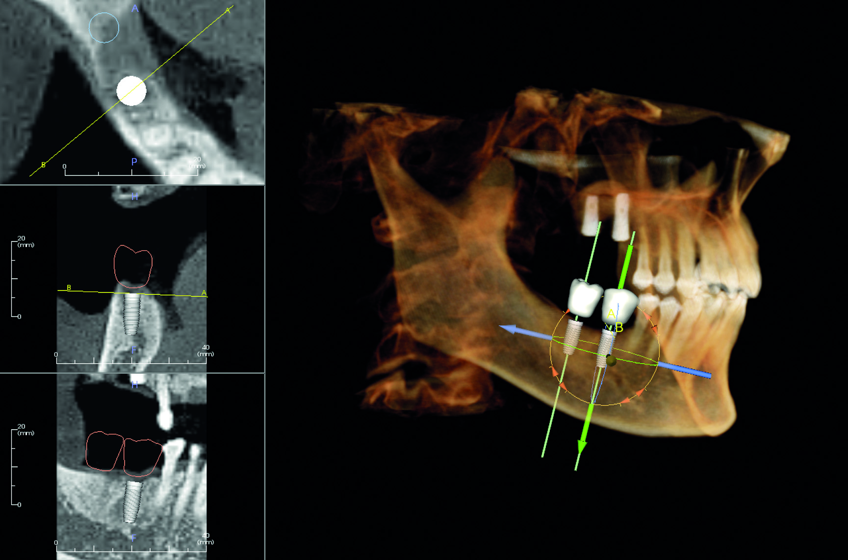KaVo Op 3D VISION implantologia