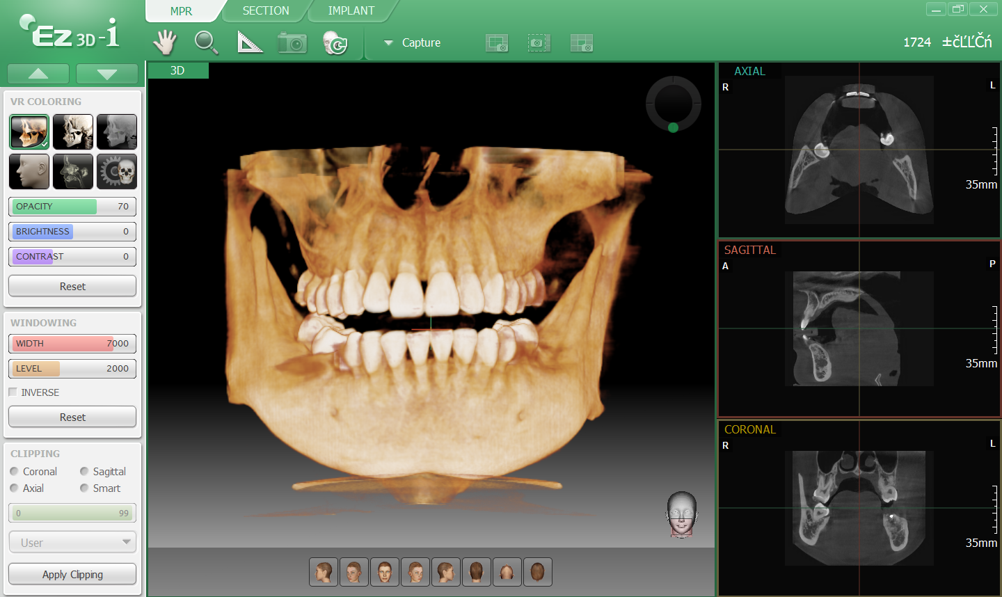Vatech Pax i 3D oprogramowanie Ez3D i