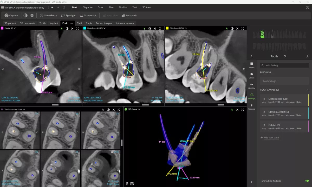 ENDO DTX STUDIO CLINIC DEXIS 2 Analiza przekrojów poprzecznych