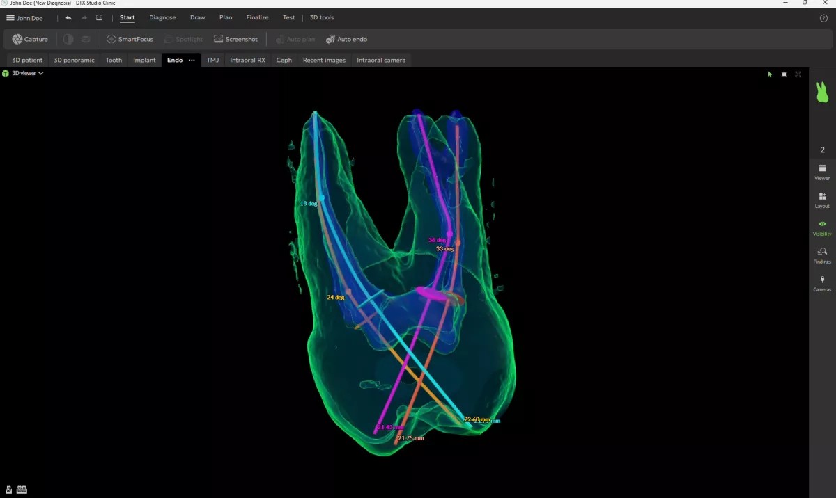 ENDO DTX STUDIO CLINIC DEXIS 3 SEGMENTACJA KANAŁÓW