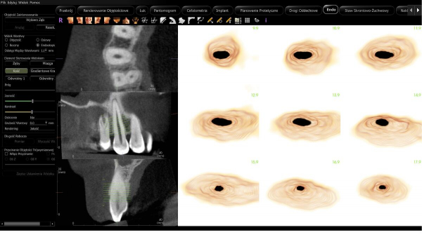 Diagnostyka CBCT KaVo w endodoncji